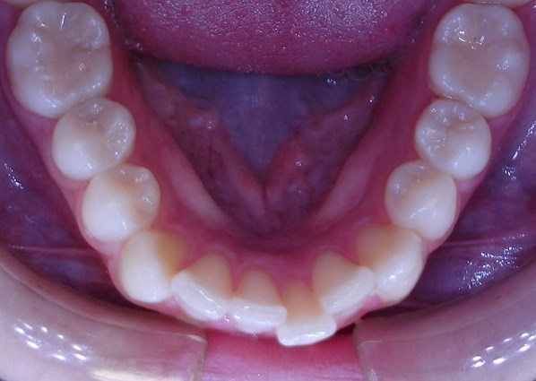 Before Wirelign® treatment at Allentown Bethlehem Lehigh Valley PA board certified orthodontist Dr. Michele Bernardich