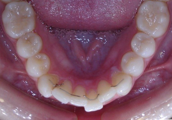 During Wirelign® treatment at Bernardich Orthodontics
