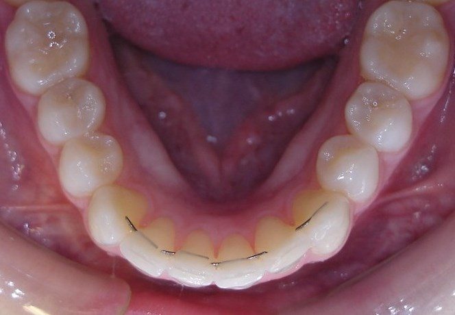 After Wirelign® treatment by Lehigh Valley board certified orthodontist Dr. Michele Bernardich