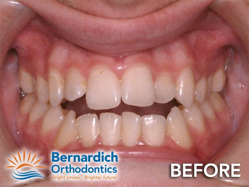 Open bite before being fixed by Invisalign treatment at Bernardich Orthodontics.